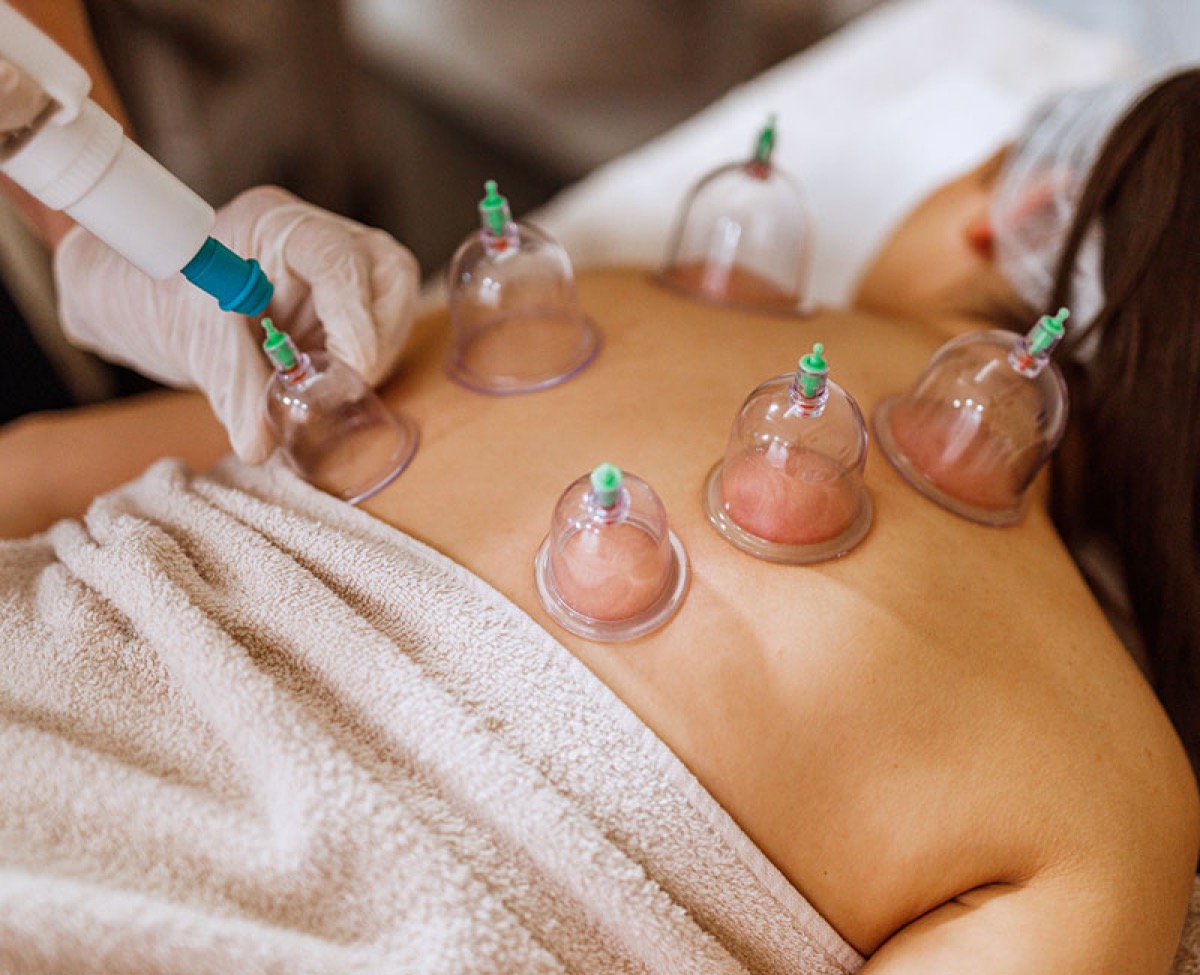 Cupping Therapy at NYC Medical Doctor PC